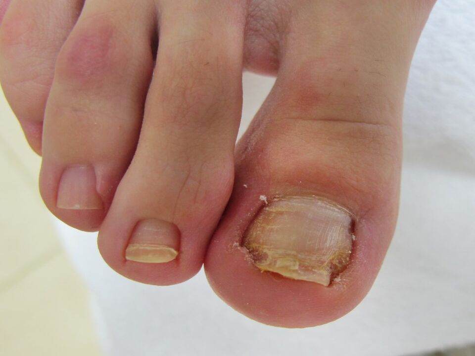 síntomas de fungo das unhas dos pés