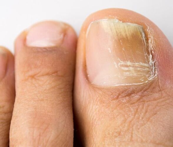 infección fúngica da unha do pé
