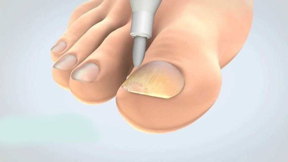 tratamento de fungos nas unhas dos pés
