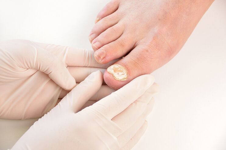 Antes de prescribir o tratamento, o médico debe diagnosticar o fungo das unhas dos pés