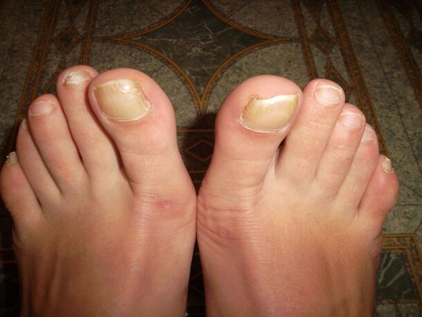 Engrosamento das uñas dos pés con onicomicose