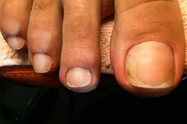 O fungo das unhas comeza no dedo gordo do pé