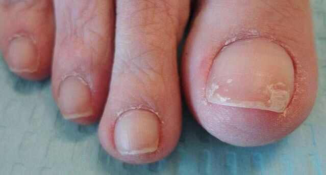 Un dos síntomas da onicomicose é o desprendemento da placa ungueal. 