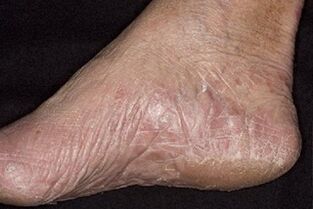 síntomas de fungo no pé