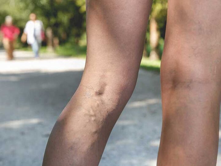 As varices son un factor de risco para a infección por fungos do pé