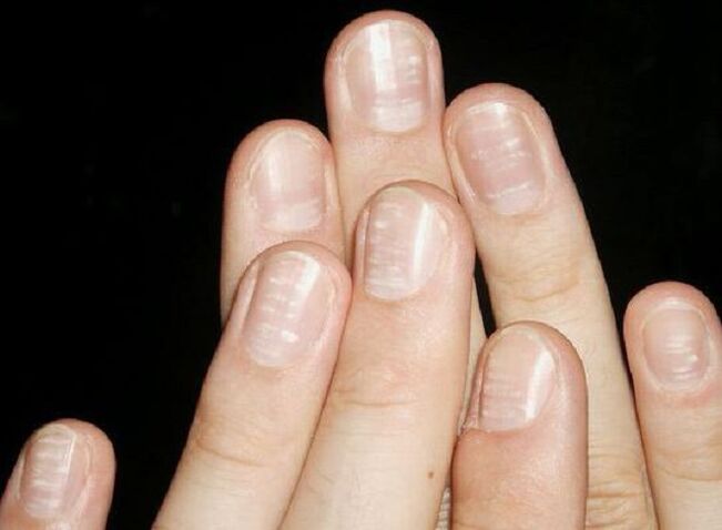 As manchas brancas nas uñas son un sinal de desenvolvemento de fungos