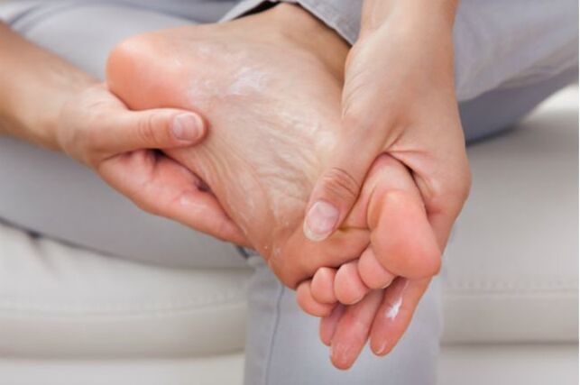 As cremas e gotas antifúngicas axudarán nas fases iniciais do fungo da unha do pé