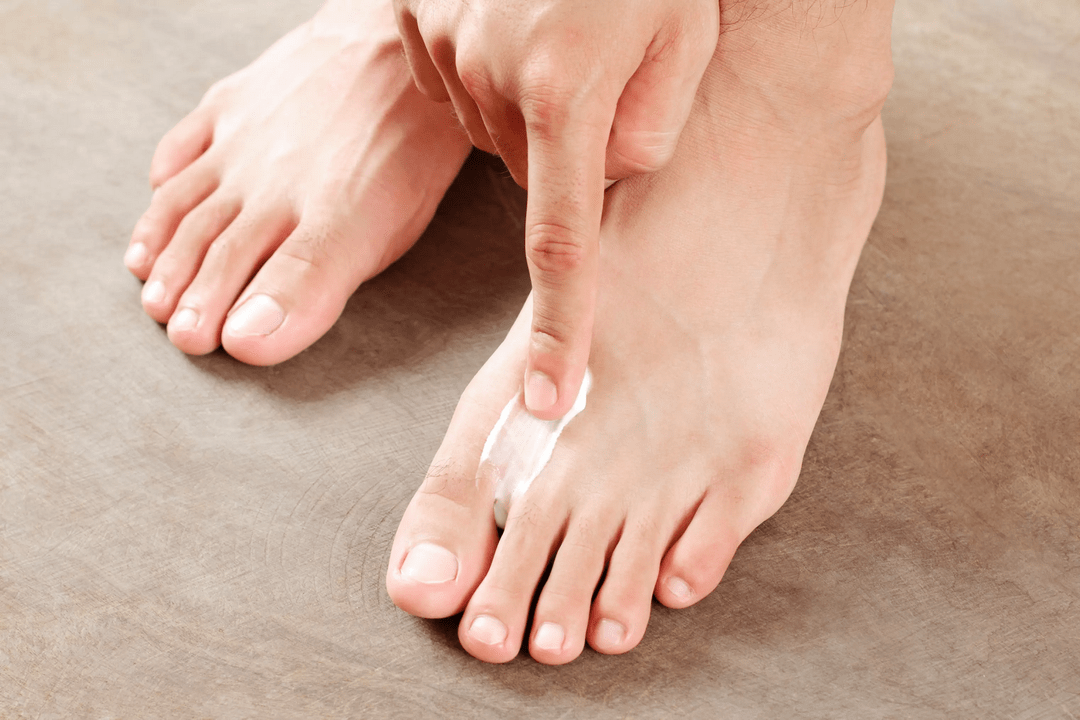 aplicando ungüento antifúngico na pel do pé