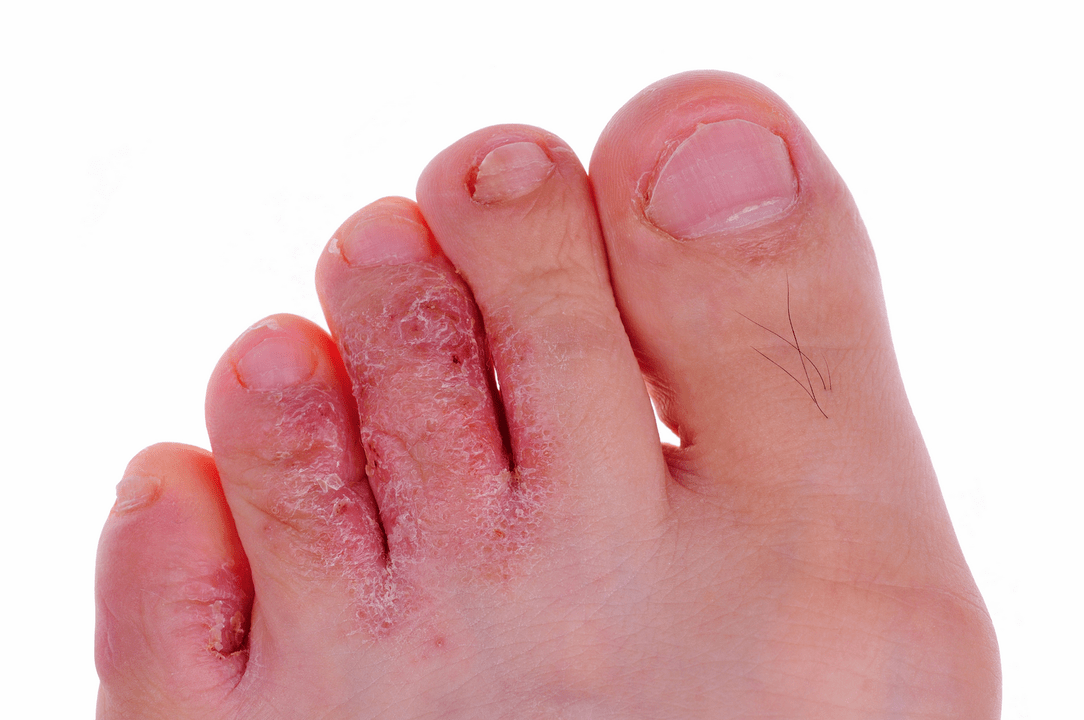 infección fúngica da pel entre os dedos dos pés