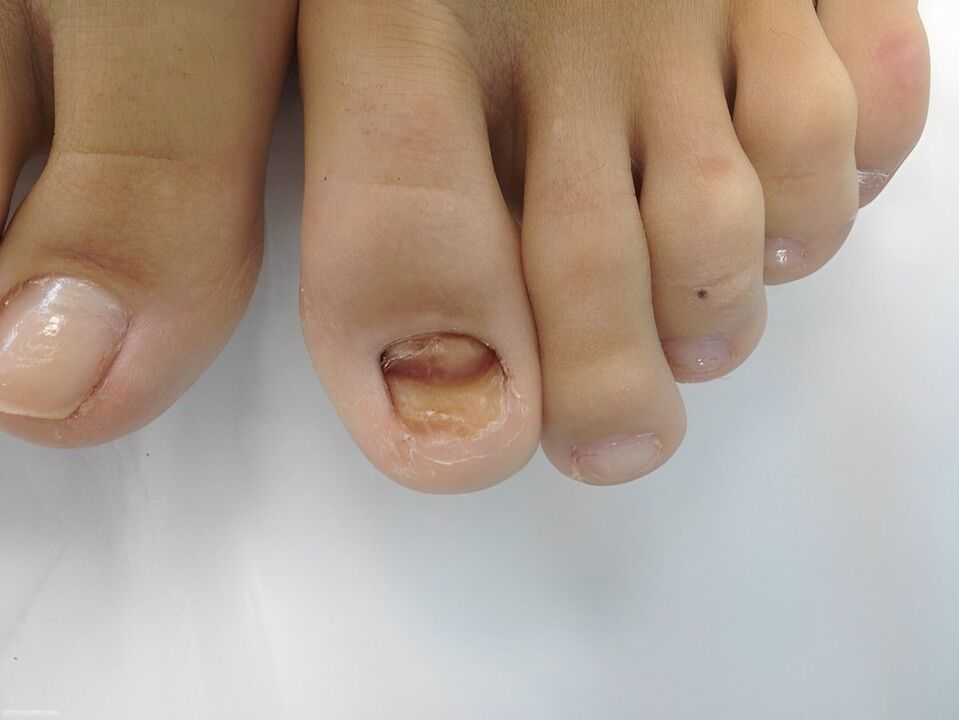 enfermidade fúngica das unhas