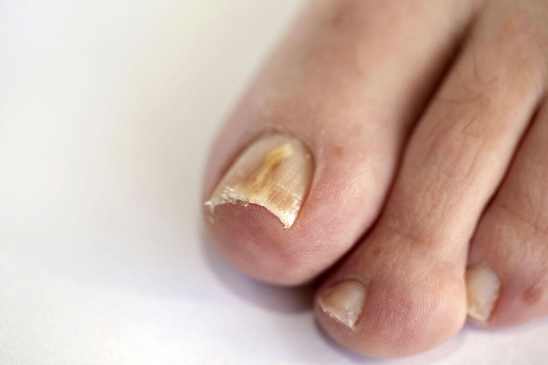 síntomas de fungo das unhas dos pés