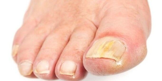 Fungo das uñas