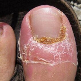 Fungo das uñas