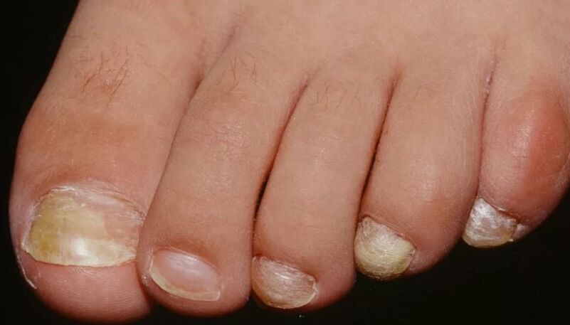 O fungo das uñas no polgar