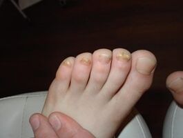 O fungo das uñas sucede incluso nos nenos