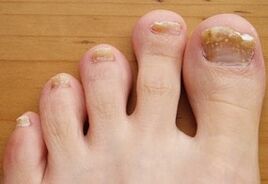 Runnou onicomicosis