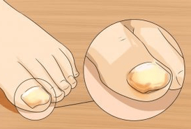 Fungo das uñas