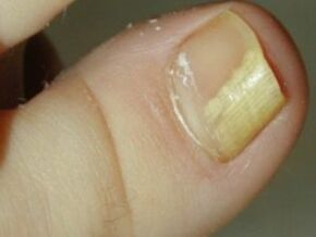 Fungo das uñas