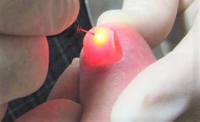 Tratamento do fungo das uñas cun láser