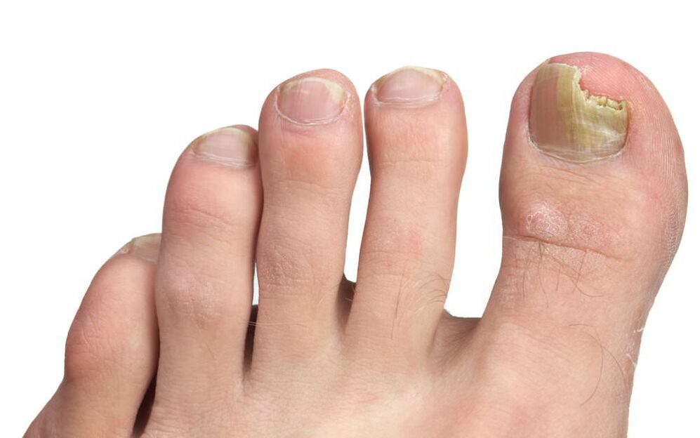 Onicomicosis