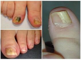 Como é o fungo nas uñas