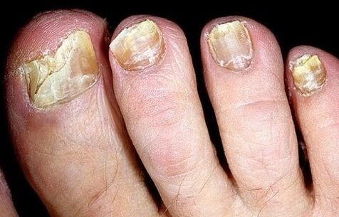 As uñas se desmoronan do fungo
