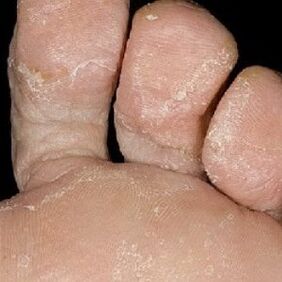 fases de fungo nas unhas