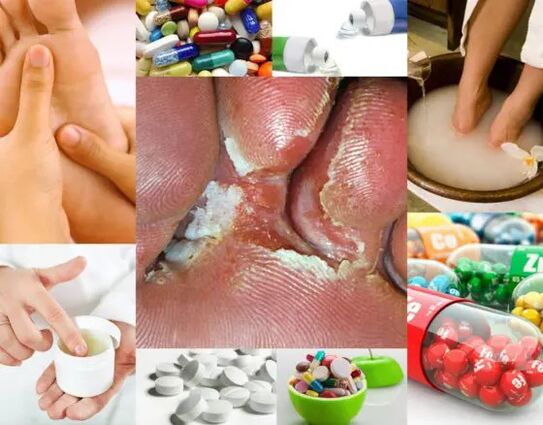 Micose interdixital e métodos de tratamento