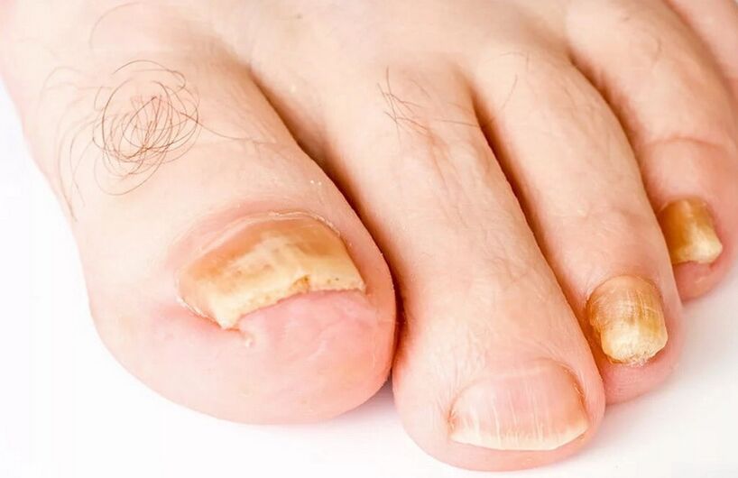 fungo das unhas dos pés
