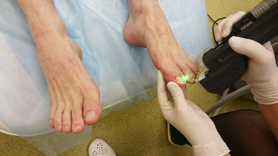terapia con láser para fungos nas unhas