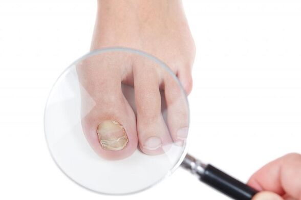etapas e fases de desenvolvemento de fungos nas unhas dos pés