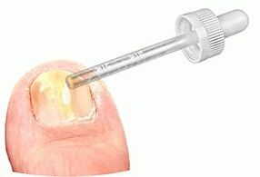 Aplicar gotas medicinais nunha unha afectada por fungos