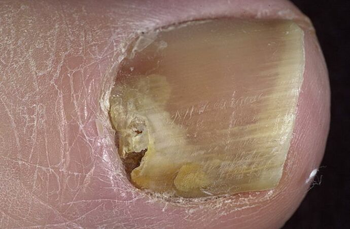 fungo nas unhas dos pés