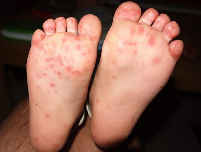 fungo vesicular nas patas