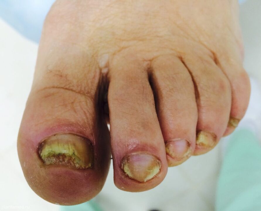 A deformación severa das uñas dos pés é un sinal da terceira fase avanzada do fungo